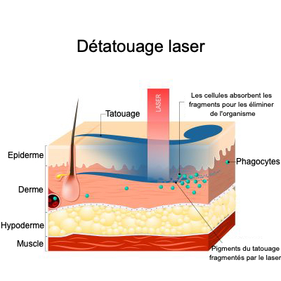 Schéma de la peau dans le détatouage laser