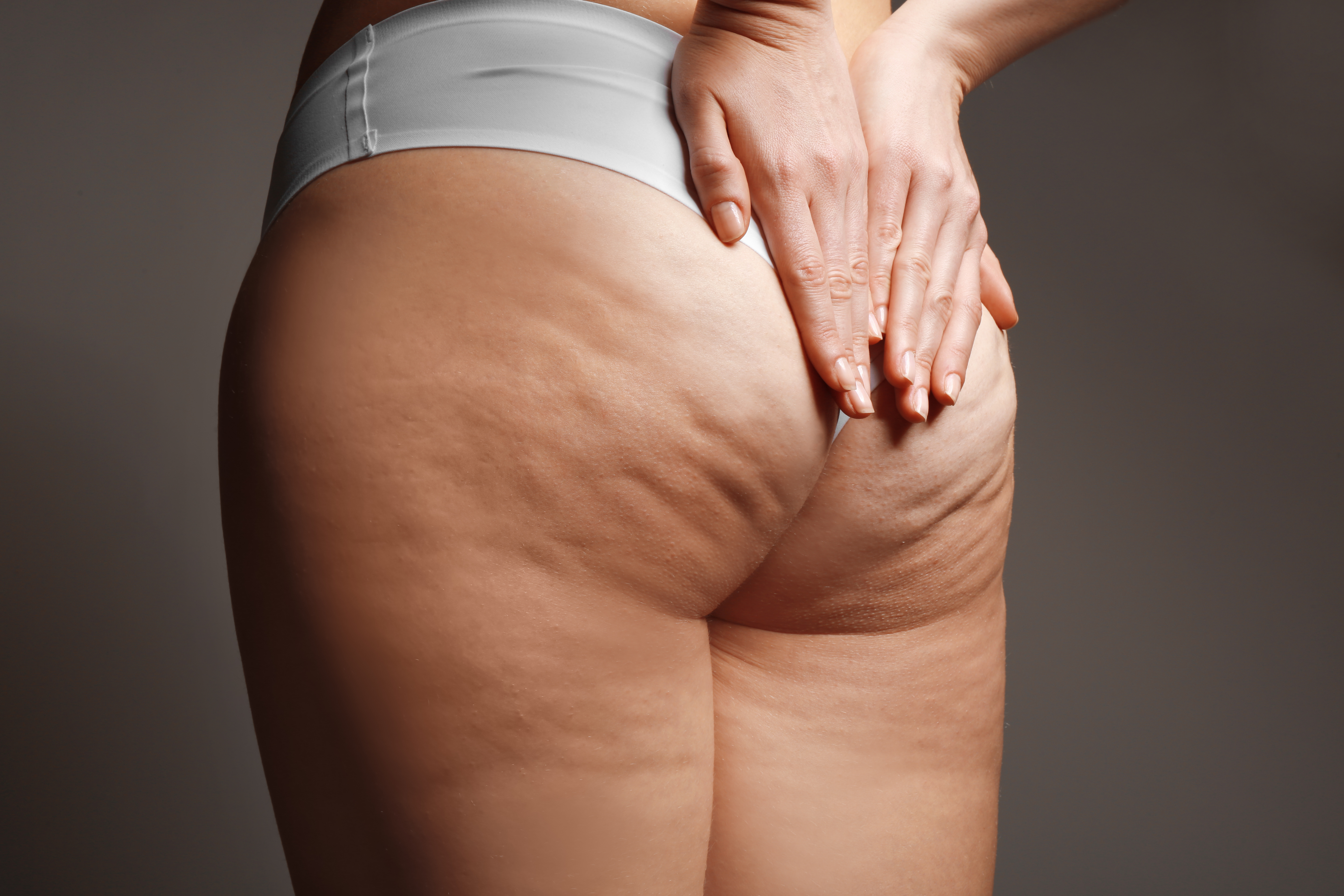 Cellulite et capiton, cabinet du Dr Christophe Klein, Génissac