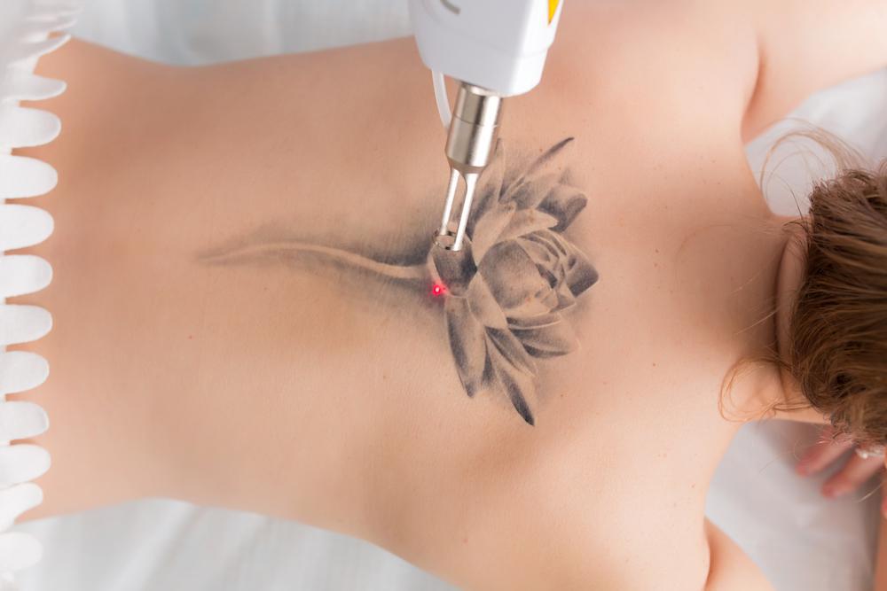 Détatouage laser au cabinet du Dr Christophe Klein, Génissac