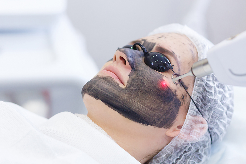 Hollywood Peel, carbon peel au laser, au cabinet du Dr Christophe Klein, Génissac