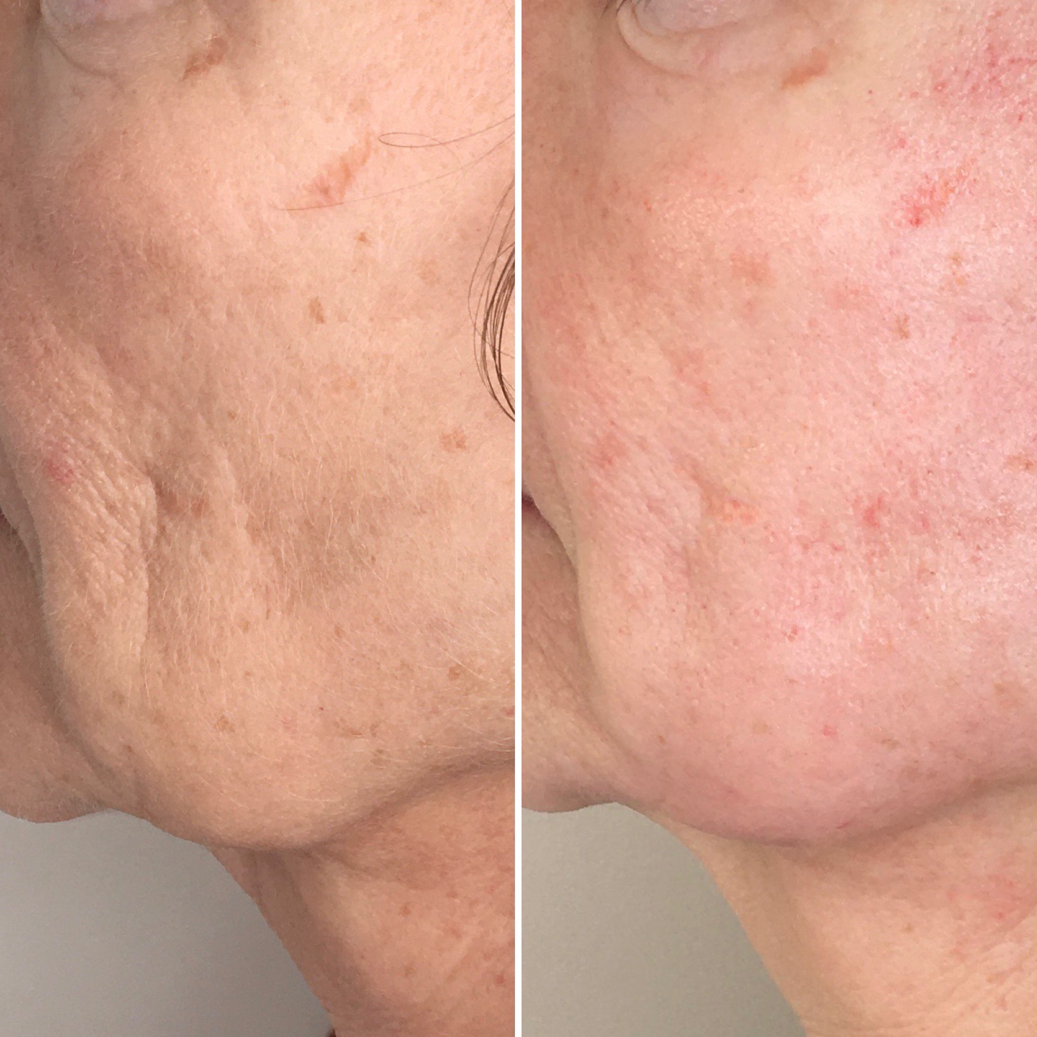 Peeling moyen TCA, cabinet du Dr Christophe Klein, Génissac