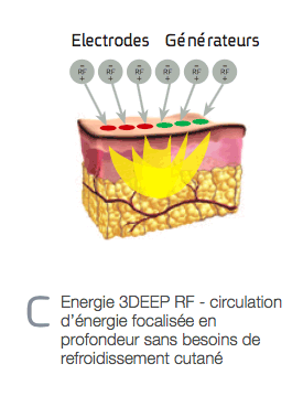 Schéma de la radiofréquence multipolaire, cabinet du Dr Christophe Klein, Génissac