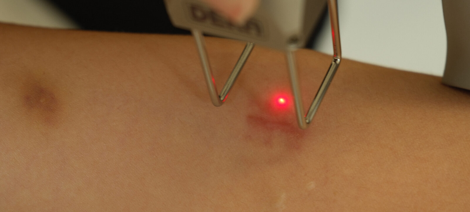 Relissage au laser CO2 fractionné (Duoglide, DEKA) au cabinet du Dr Christophe Klein