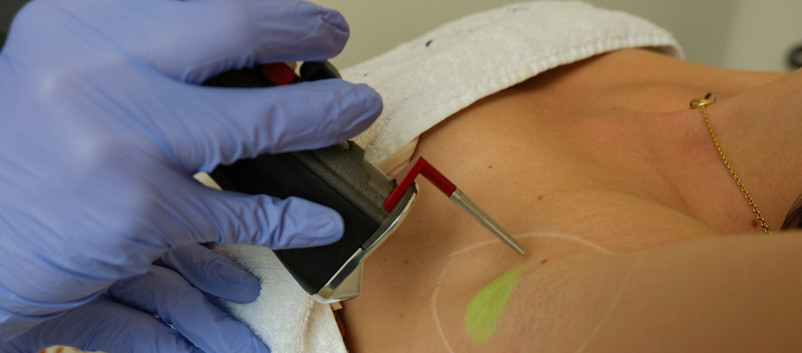 Épilation au laser au cabinet du Dr Christophe Klein à Génissac