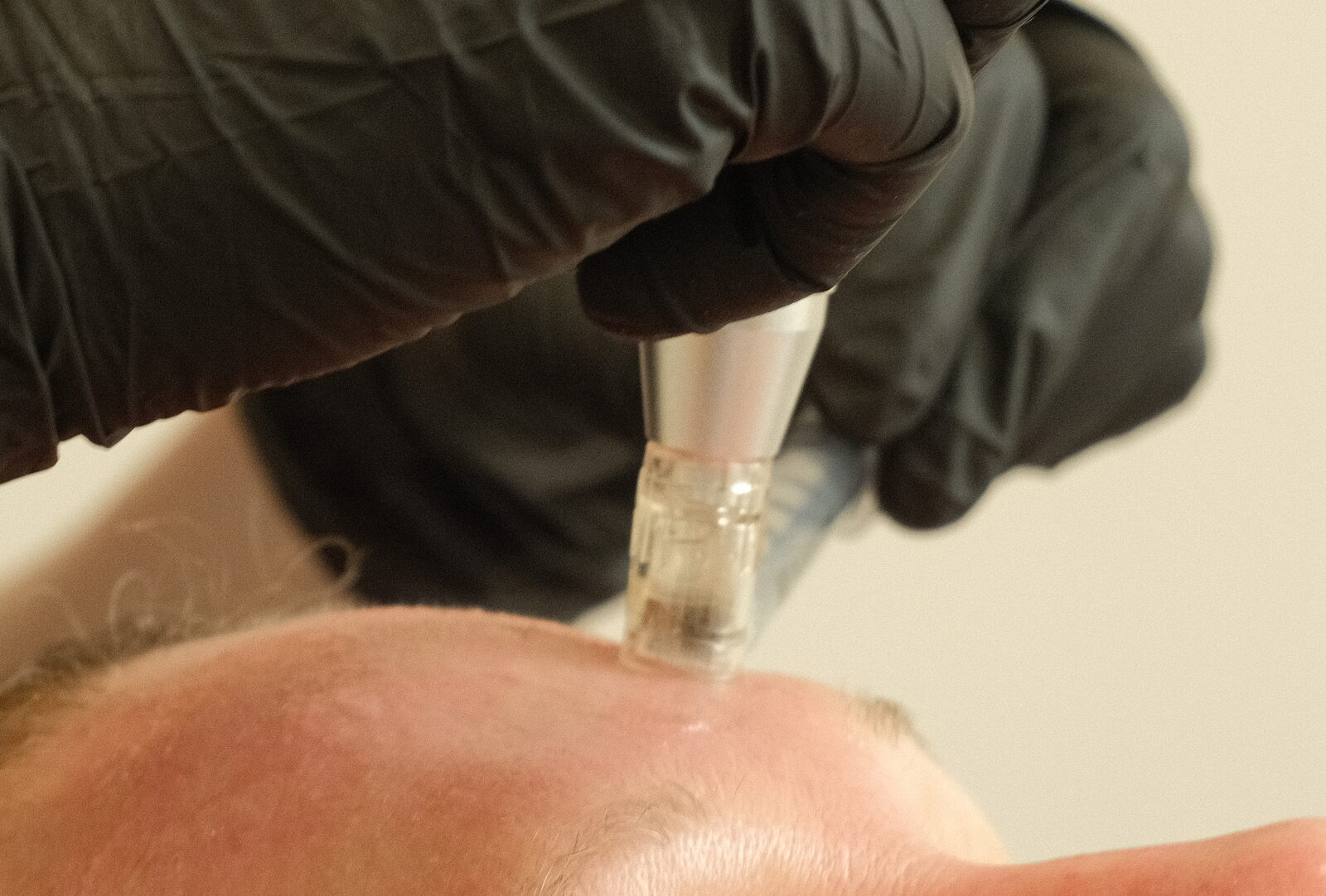 Cartouche de microneedling appliquée sur la peau pendant une séance de mésothérapie revitalisante