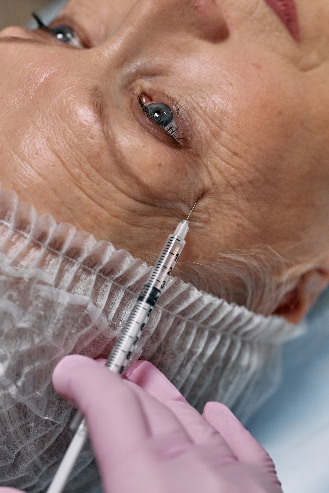 Micro-injection de skinbooster dans la peau, au cabinet du Dr Christophe Klein