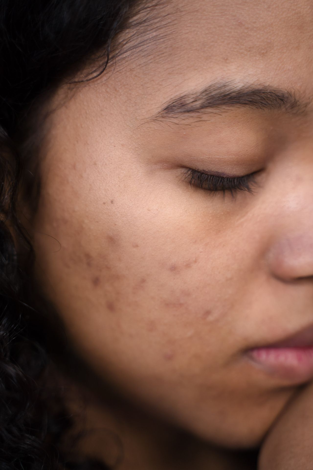 Gros plan de peau du visage avec de l'acné et des imperfections