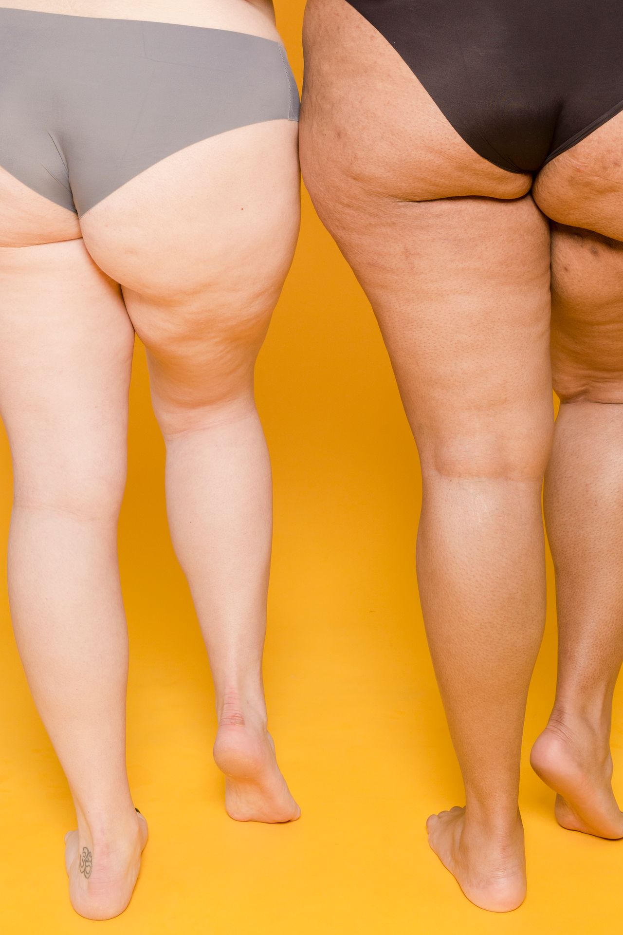 Aspect peau d'orange (cellulite) sur les cuisses