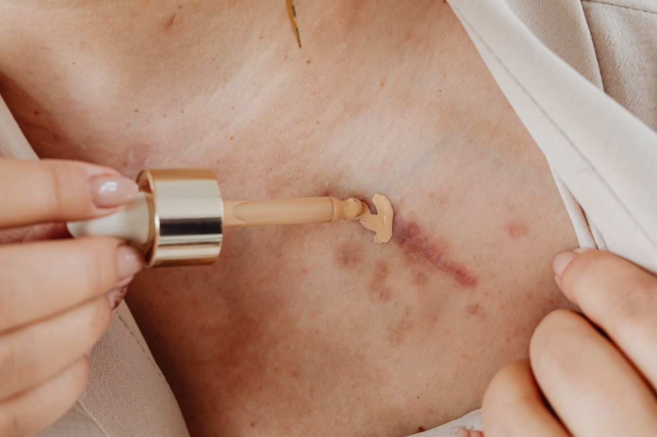 Gros plan de peau présentant des cicatrices d'acné