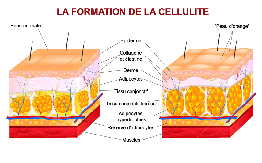 Schéma explicatif de la cellulite