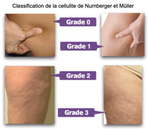 Classification de la cellulite (Nürnberger-Müller)