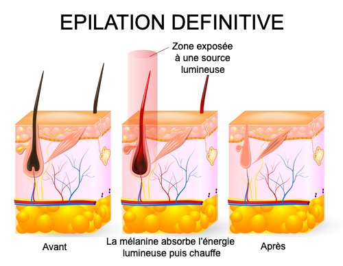 Épilation définitive au laser, illustration